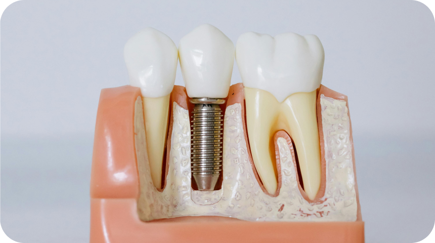 Couronne dentaire à Toulouse Dentiste à Toulouse, Dentiste Mathieu Benichou