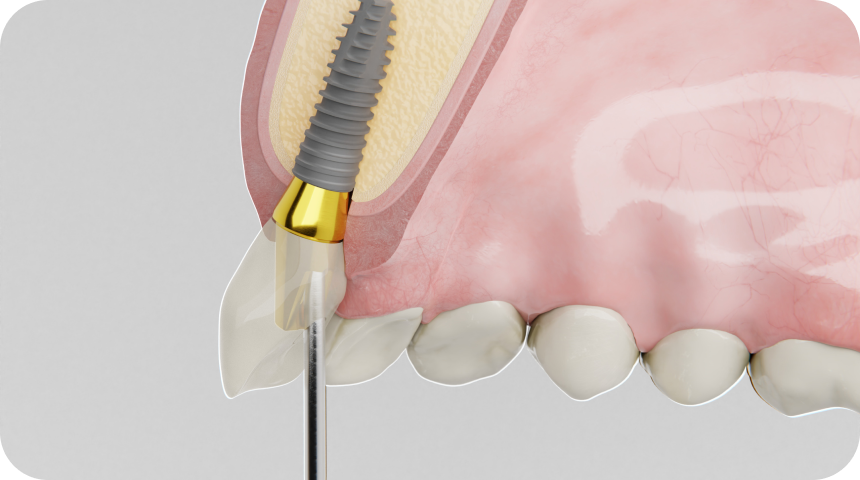 Couronne dentaire à Toulouse Dentiste à Toulouse, Dentiste Mathieu Benichou