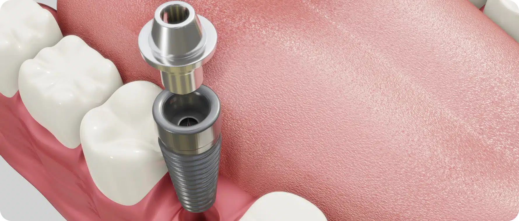 Implant dentaire à Toulouse Dentiste à Toulouse, Dentiste Mathieu Benichou