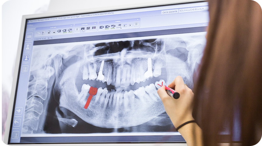 Implant dentaire à Toulouse Dentiste à Toulouse, Dentiste Mathieu Benichou