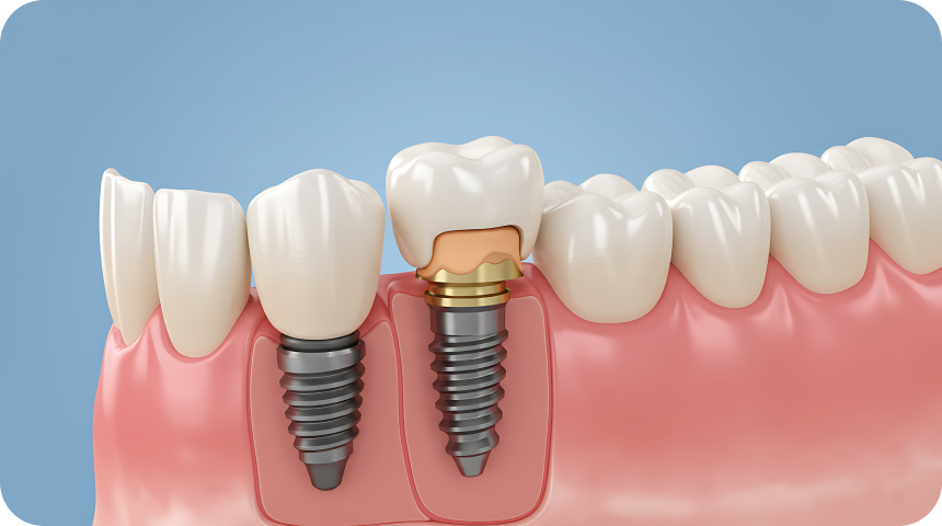 Implant dentaire à Toulouse Dentiste à Toulouse, Dentiste Mathieu Benichou