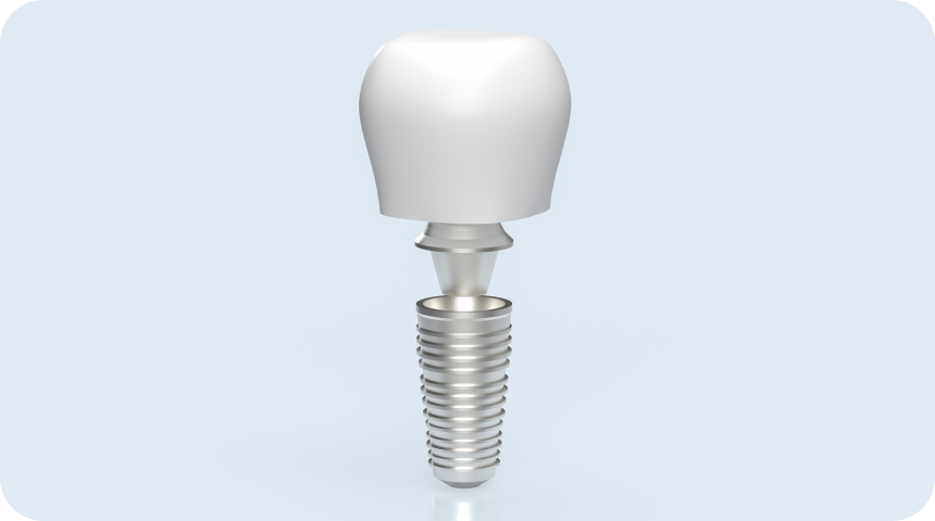 Implant dentaire à Toulouse Dentiste à Toulouse, Dentiste Mathieu Benichou