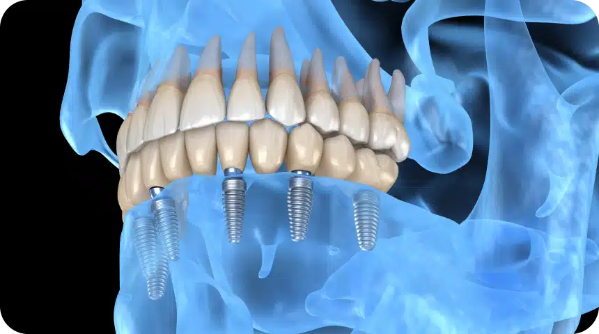 Combien d'implants dentaires peut-on poser en une fois ? Dentiste à Toulouse, Dentiste Mathieu Benichou