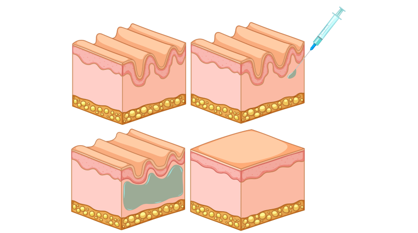 Injection d’acide hyaluronique pour les lèvres et le sillon naso-génien à Toulouse Dentiste à Toulouse, Dentiste Mathieu Benichou