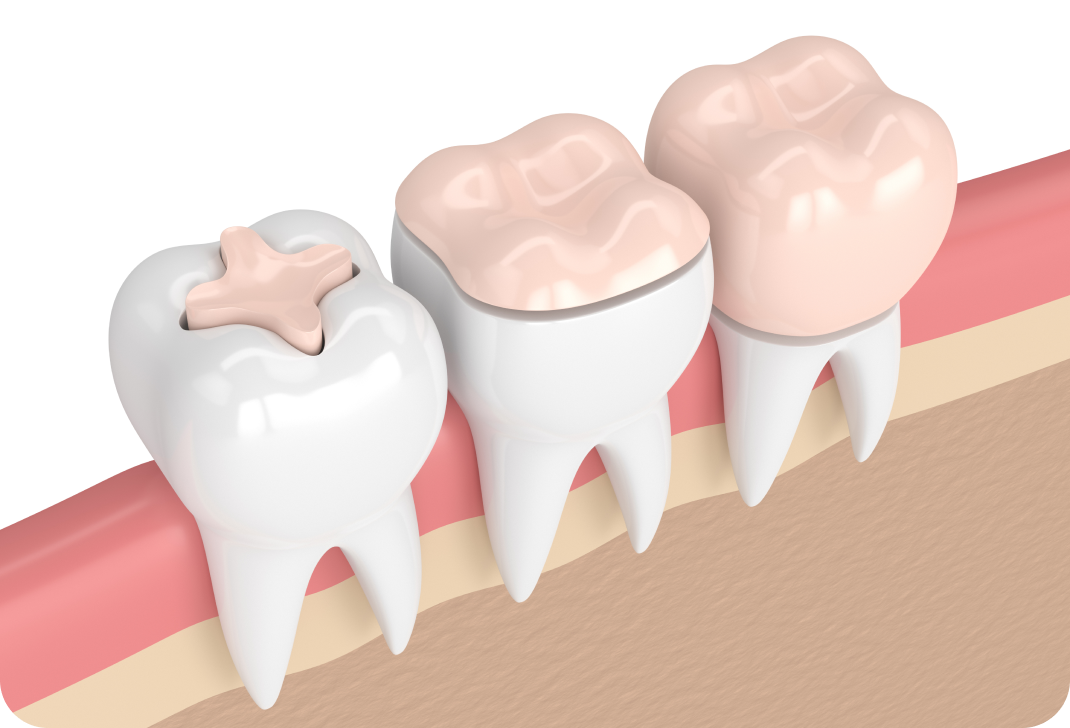 Prothèses fixes, Inlay-Onlay à Toulouse Dentiste à Toulouse, Dentiste Mathieu Benichou