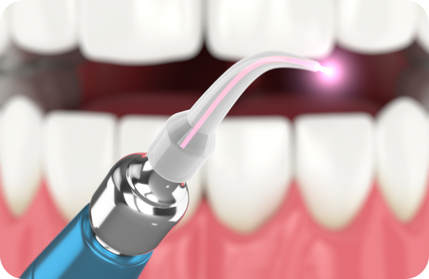 L'utilisation du laser diode dans la désinfection canalaire Dentiste à Toulouse, Dentiste Mathieu Benichou