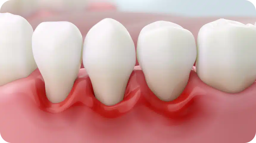 Maladie parodontale : causes, symptômes et traitements ! Dentiste à Toulouse, Dentiste Mathieu Benichou