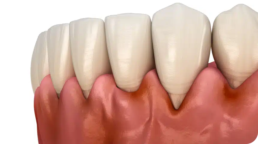 Parodontite : avis de dentiste, causes et traitements  Dentiste à Toulouse, Dentiste Mathieu Benichou