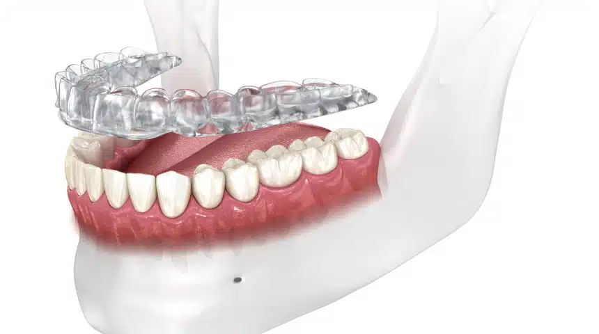 Comprendre le bruxisme et le clenching Dentiste à Toulouse, Dentiste Mathieu Benichou