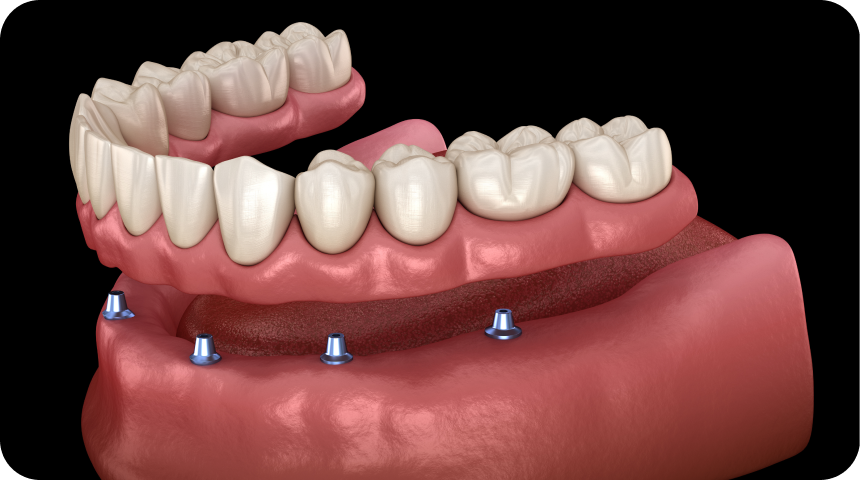 Prothèse dentaire Toulouse Dentiste à Toulouse, Dentiste Mathieu Benichou