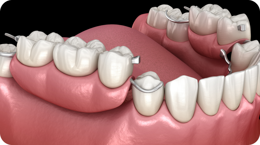Prothèse dentaire Toulouse Dentiste à Toulouse, Dentiste Mathieu Benichou