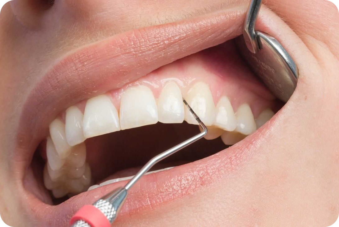 Parodontologie à Toulouse Dentiste à Toulouse, Dentiste Mathieu Benichou