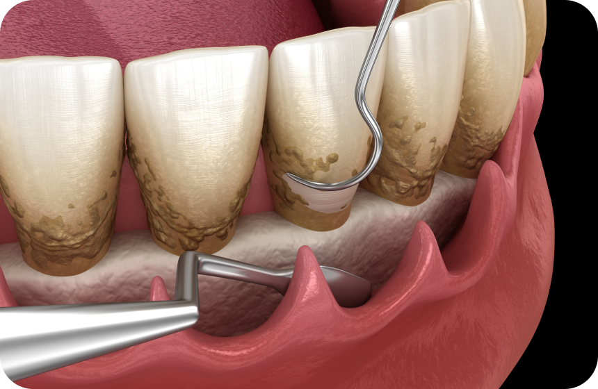 Surfaçage radiculaire : guide du traitement et conseils Dentiste à Toulouse, Dentiste Mathieu Benichou