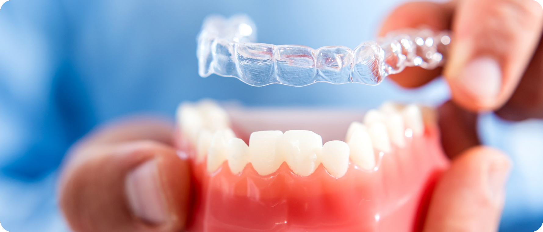 Invisalign avant après 3 mois ; Traitement orthodontique à Toulouse, Dr Mathieu Benichou