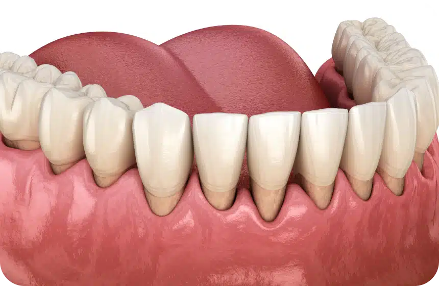 Comment identifier une gencive rétractée ? Les causes principales de la récession gingivale
