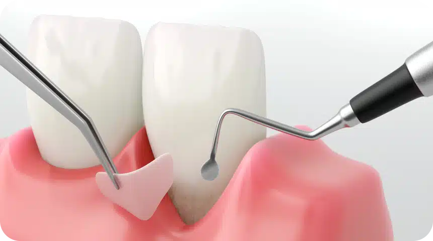 Gencive rétractée Dentiste à Toulouse, Dentiste Mathieu Benichou