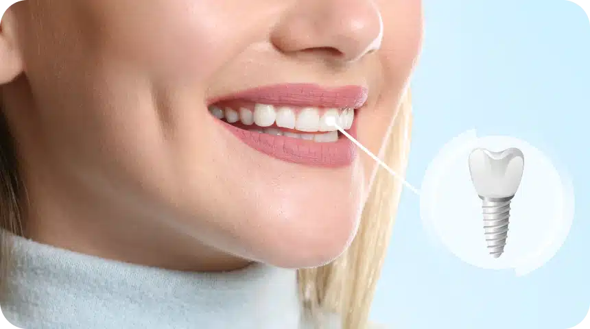 Durée de vie d'un implant dentaire à Toulouse Dentiste à Toulouse, Dentiste Mathieu Benichou
