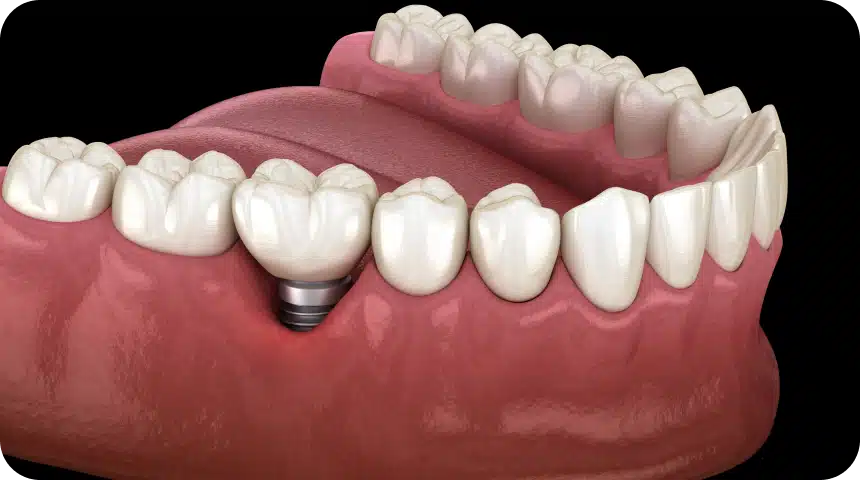 Infection d'un implant dentaire (péri-implantite) : symptômes et que faire Dentiste à Toulouse, Dentiste Mathieu Benichou