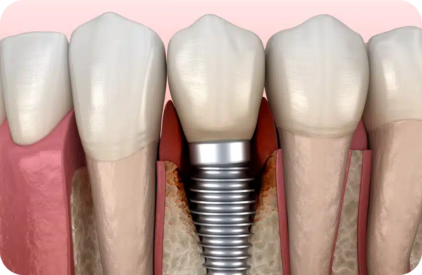 Infection d'un implant dentaire (péri-implantite) : symptômes et que faire Dentiste à Toulouse, Dentiste Mathieu Benichou