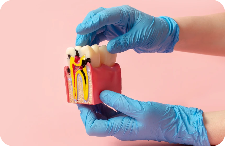 Carie dentaire à Toulouse : symptômes, radio et traitements Dentiste à Toulouse, Dentiste Mathieu Benichou