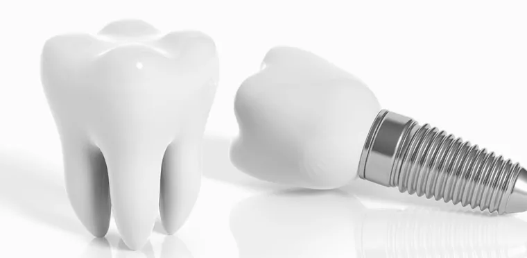 Délai entre une extraction dentaire et la pose d’un implant ?