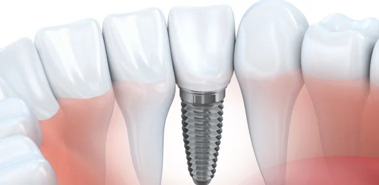 Peut-on retirer un implant dentaire ?
